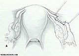 Click image for larger version

Name:	Tubal-Reversal-Surgery.jpg
Views:	33
Size:	29.0 KB
ID:	62661